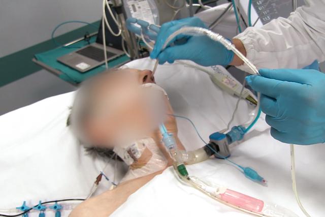Inserción de catéter esofágico con globo en un paciente