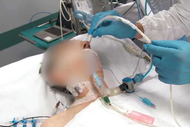 Insertion d'un cathéter à ballonnet œsophagien sur un patient