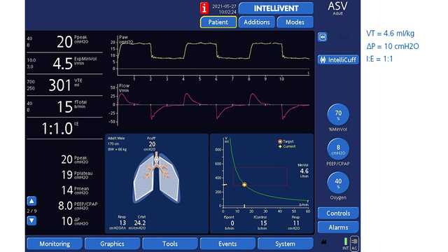 Display showing dynamic lung and ASV graph