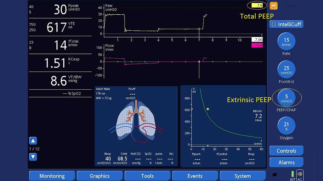 Schermata del ventilatore con la manovra di pausa espiratoria visualizzata