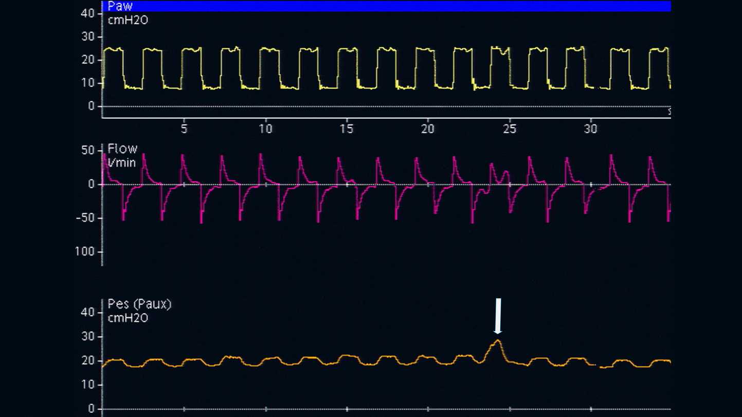 Screenshot of waveform showing Pes increase