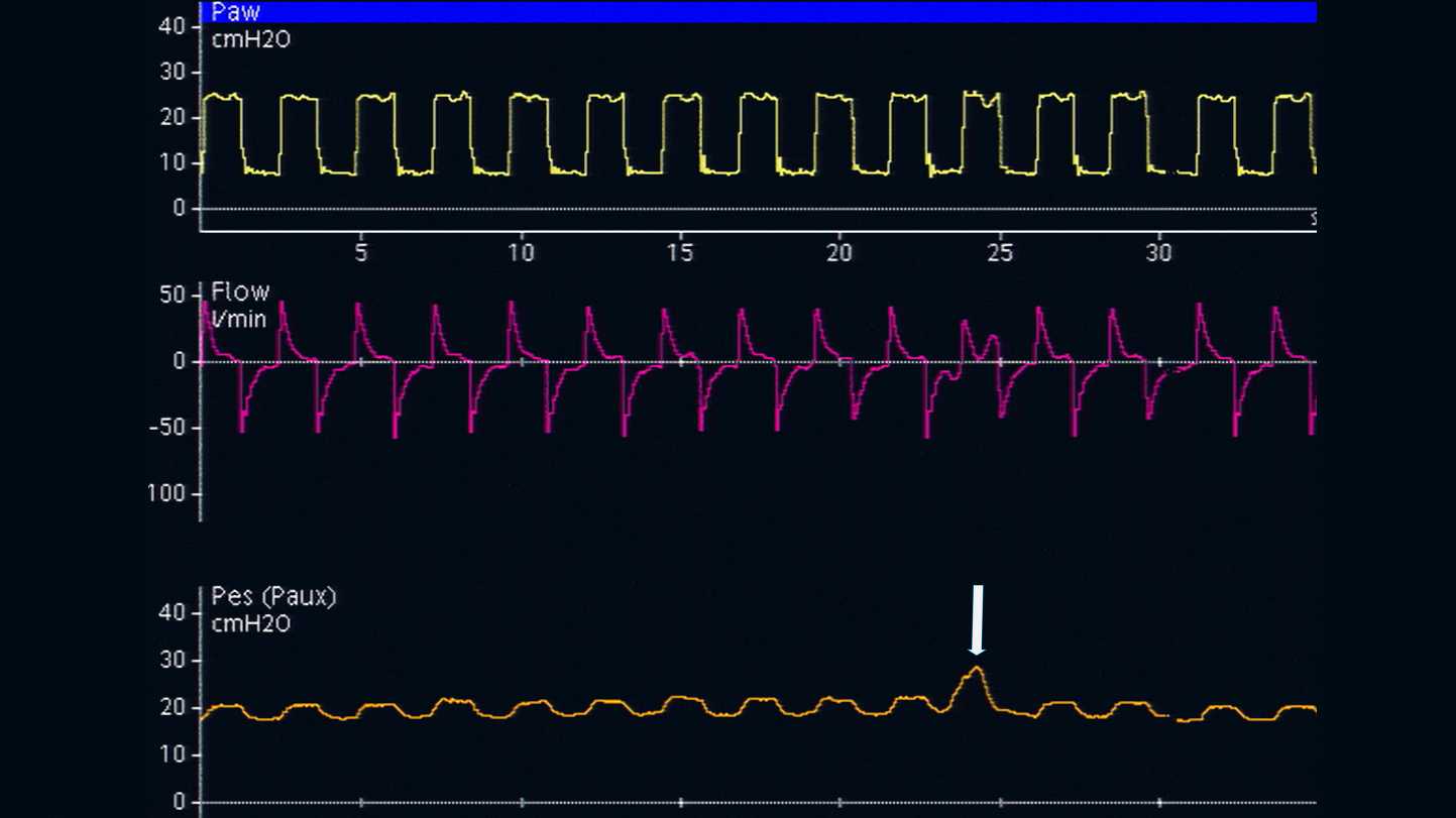 Capture d'écran d'une forme d'ondes affichant l'augmentation de la Pes