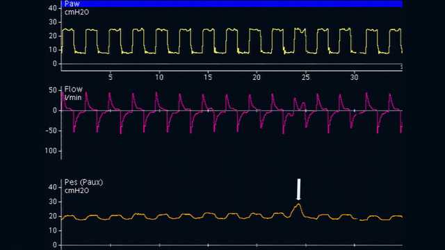 How to measure esophageal pressure correctly