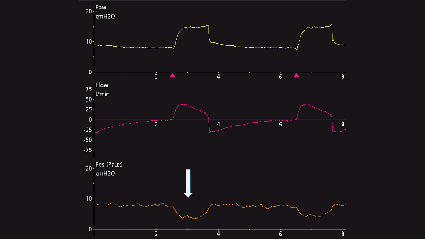 How to measure esophageal pressure correctly