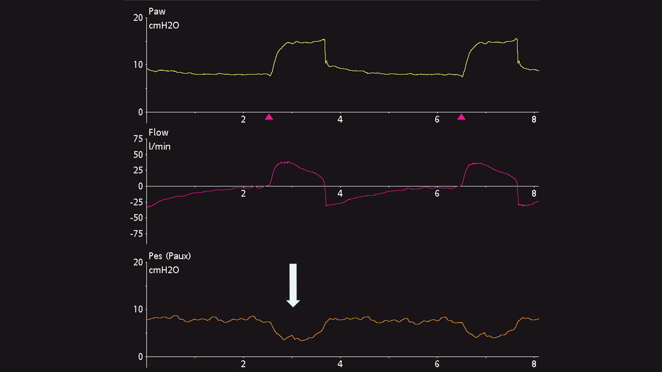 Waveform showing Pes deflections in spontaneous patient