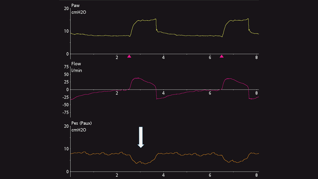Forma de onda que muestra desvíos de la Pes en un paciente con respiración espontánea