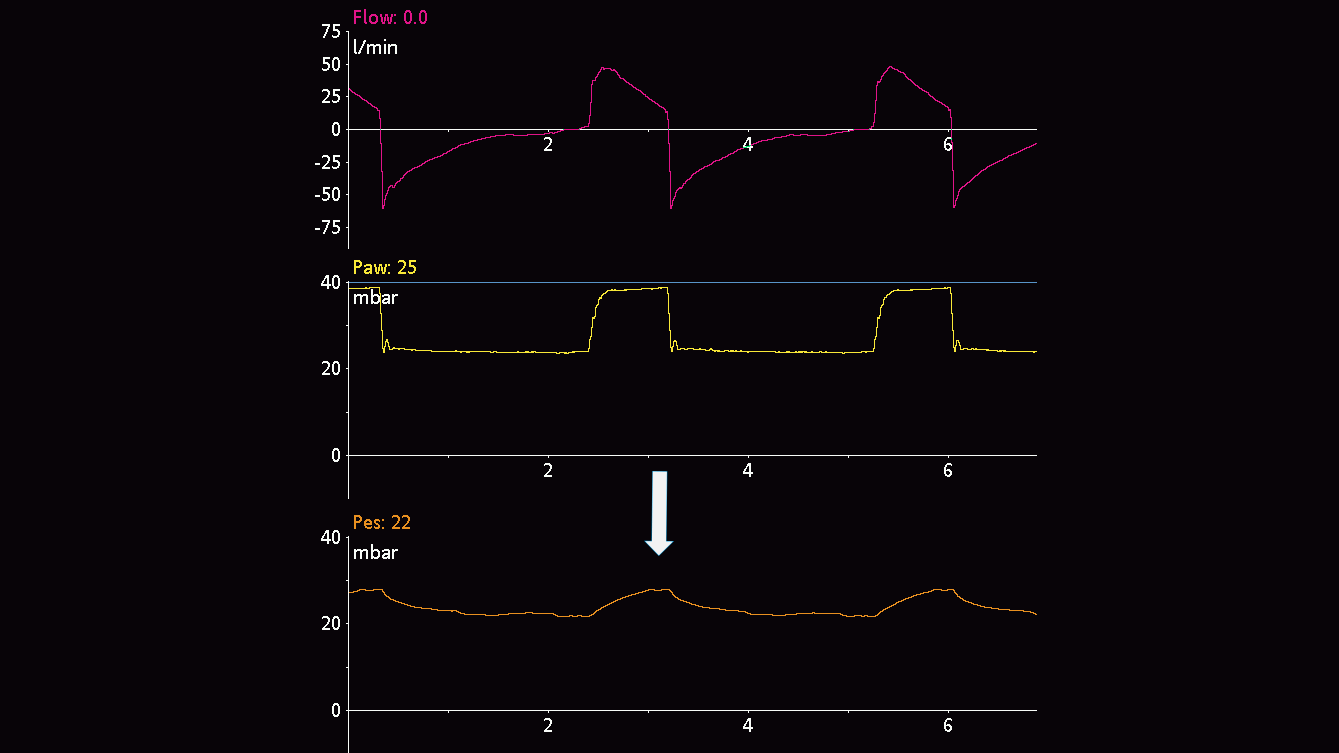 Waveform showing Pes deflections in passive patient