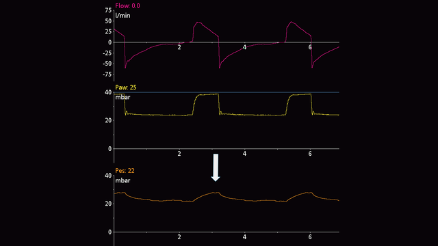 Forma de onda que muestra desvíos de la Pes en un paciente con respiración pasiva