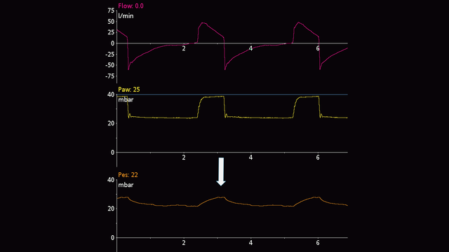 Waveform showing Pes deflections in passive patient