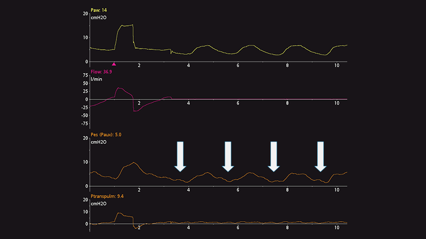 Waveform showing decrease in Paw and Pes; no change in Ptranspulm