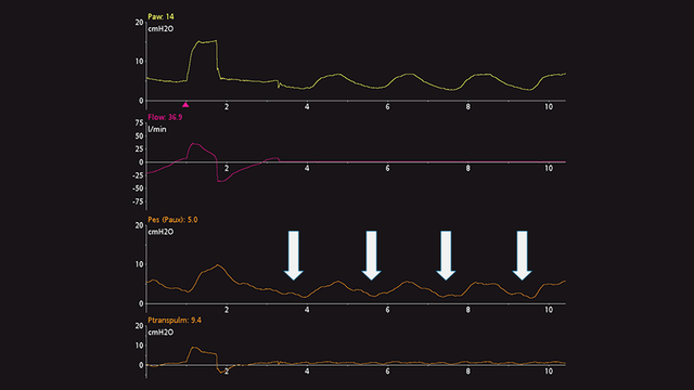 Waveform showing decrease in Paw and Pes; no change in Ptranspulm