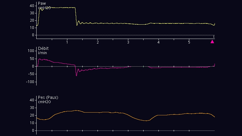 Screenshot of waveforms for airway pressure, flow, and esophageal pressure 