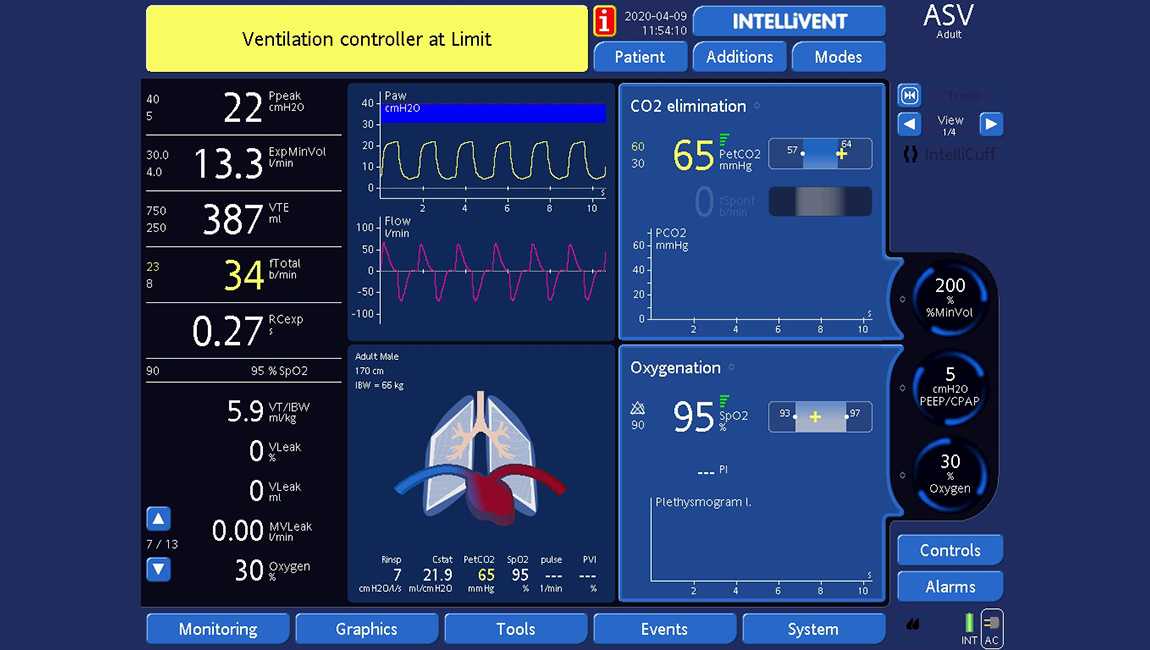 Screenshot of ventilator display showing alarm bar