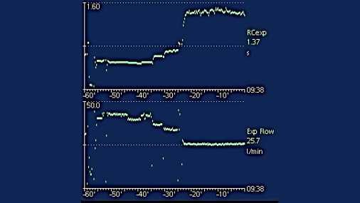 Screenshot showing trends for exp flow and RCecp