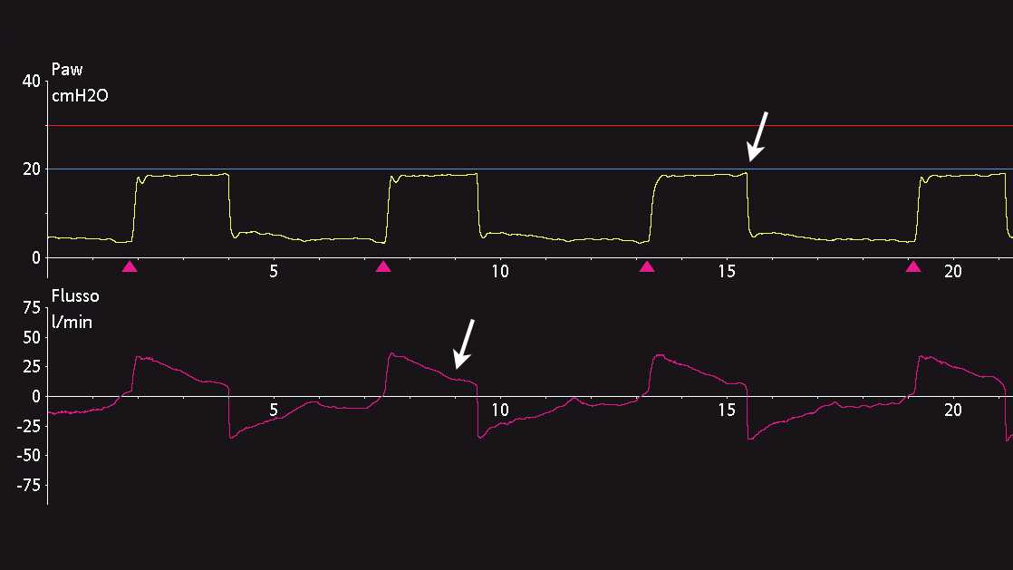 Captura de pantalla de formas de onda de flujo y presión que muestran un cambio en la pendiente del flujo