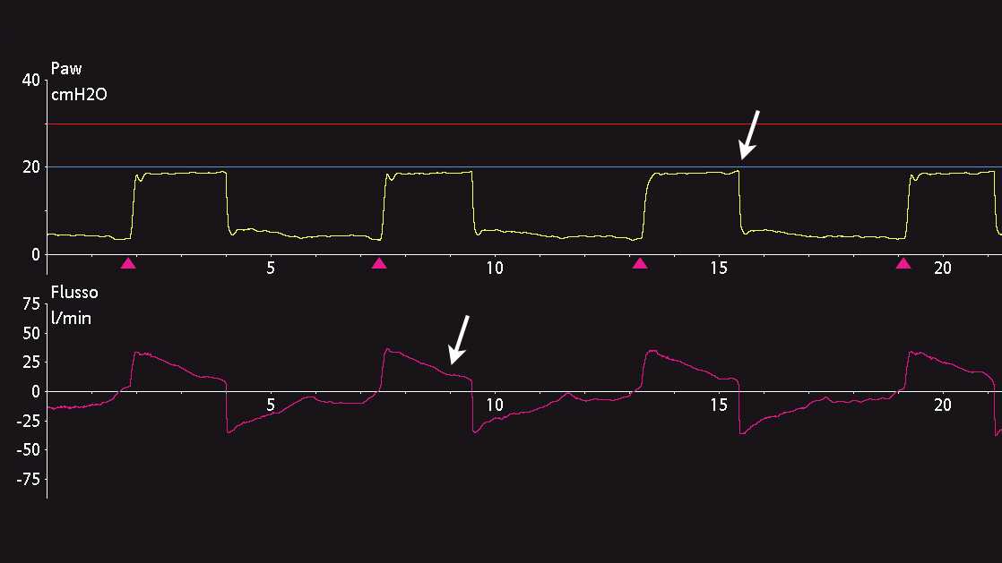 Schermata che mostra le curve di pressione e flusso sottolineando la variazione della pendenza nella curva del flusso