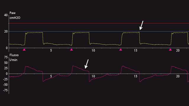 Screenshot of flow and pressure waveform showing change in slope of flow