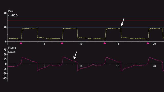 Screenshot of flow and pressure waveform showing change in slope of flow