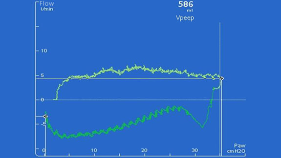 Screenshot of ventilator display showing airway pressure and flow plot