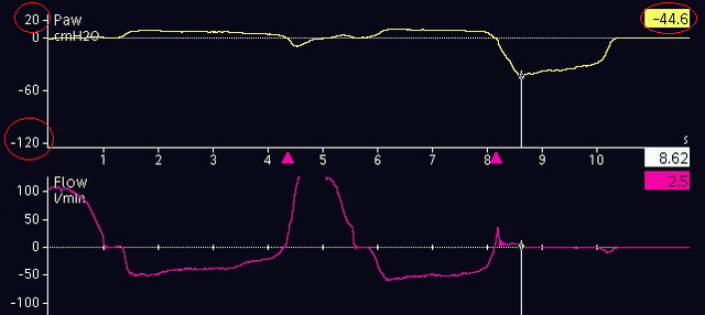 Measurement of maximal inspiratory pressure (or NIF)