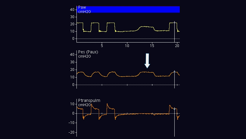 显示气道压和食道压增加、跨肺压无变化的波形