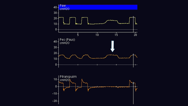 Forme d'ondes affichant une augmentation de la Paw et de la Pes ; aucun changement de la Ptranspulm