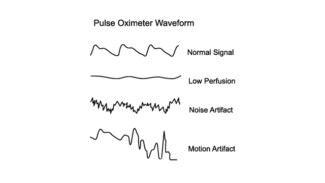 Image showing pulse oximeter waveforms for different signals