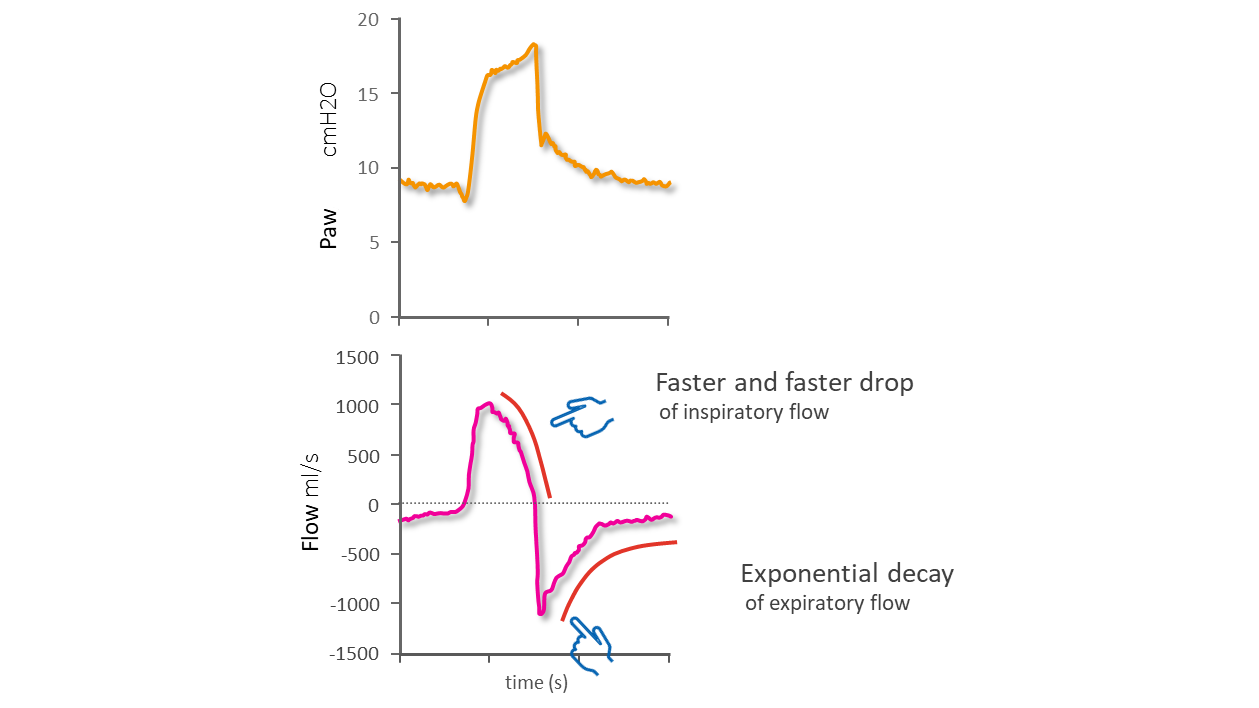 Using waveforms to indentify asynchronies Step 1 Hamilton Medical
