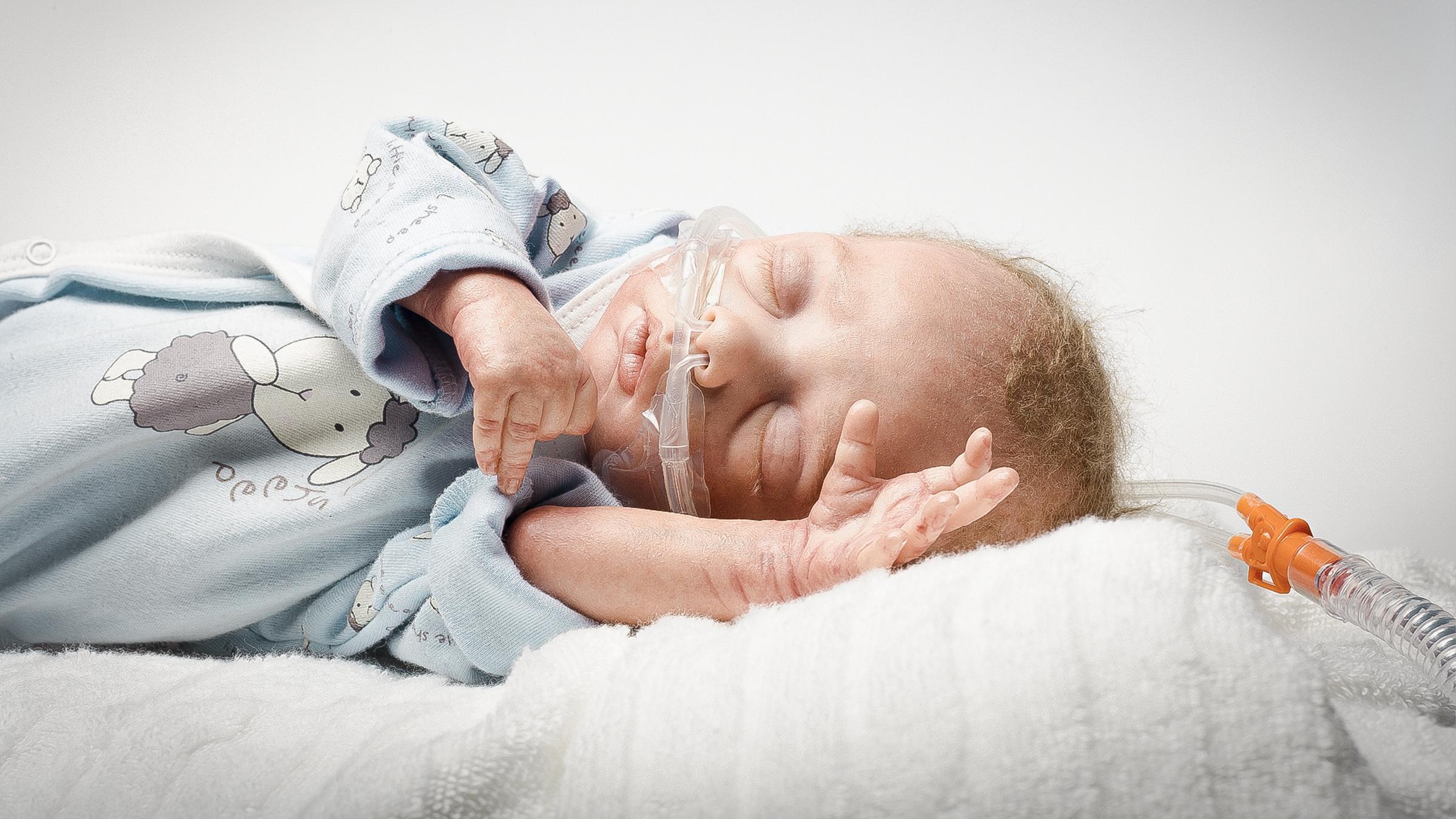 Sleeping baby with Nuflow® nasal cannula