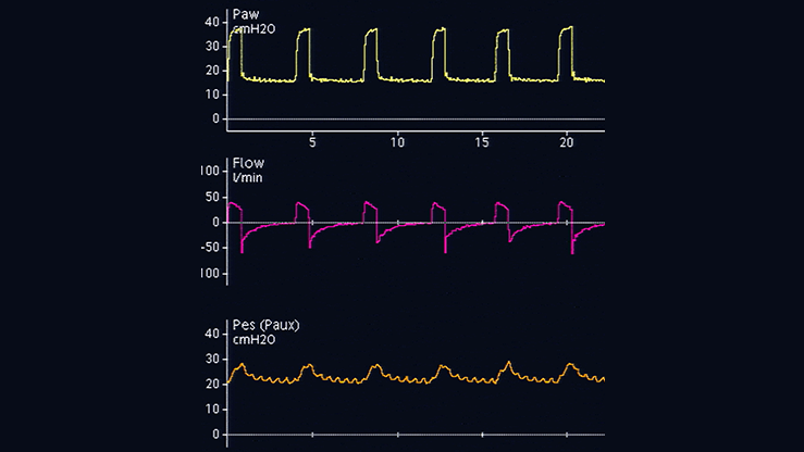 Forma de onda que muestra la línea de referencia de la presión esofágica
