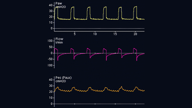 Waveform showing baseline for esophageal pressure