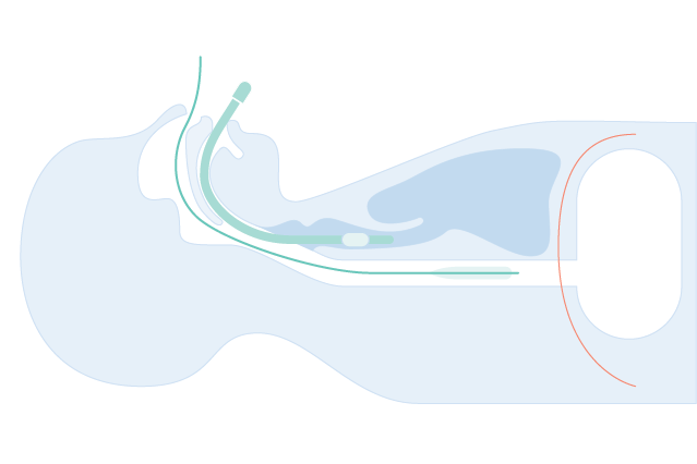 Esophageal catheter