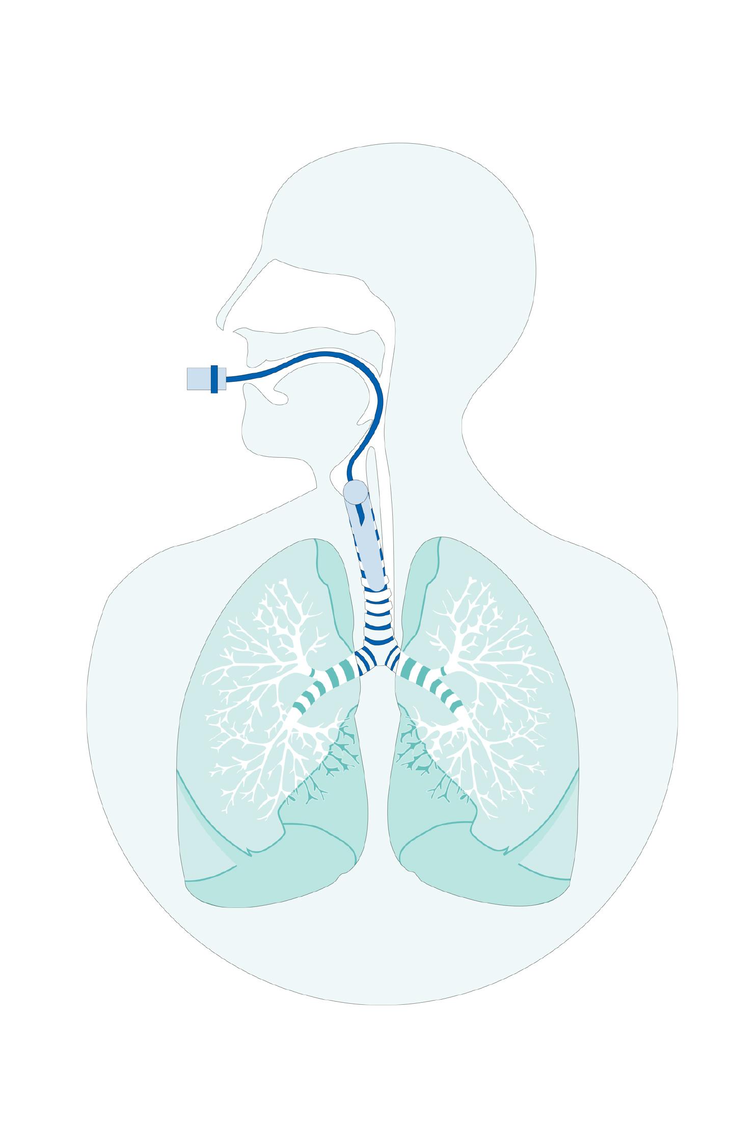 Graphical illustration: controlled cuff pressure