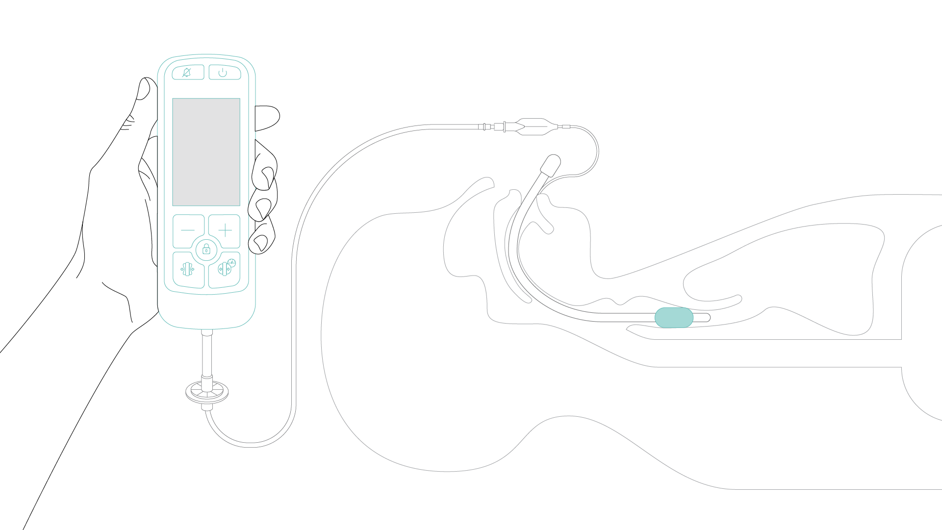 Collage of IntelliCuff use fields