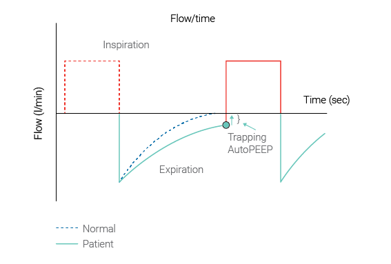 Grafico flusso/tempo che mostra l'AutoPEEP e l'intrappolamento di aria