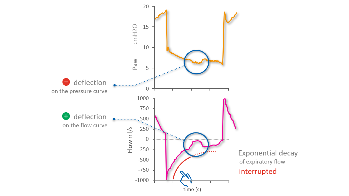 Flow and pressure waveforms with simultaneous activity