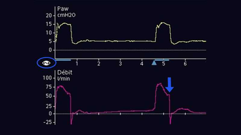 Display showing pressure and flow waveforms with IntelliSync+ activated.