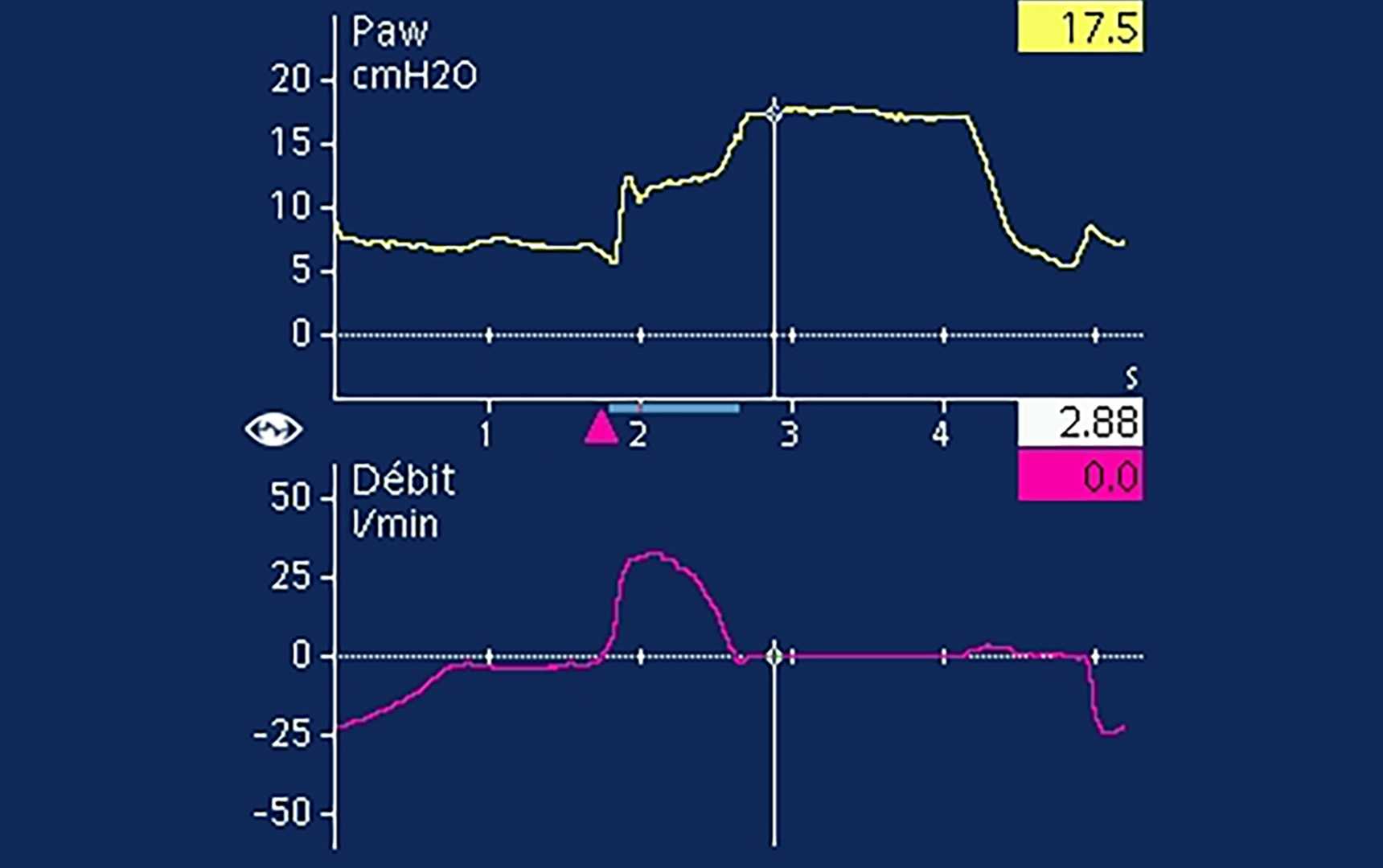 Screenshot showing pressure and flow waveforms with visible plateau on flow waveform