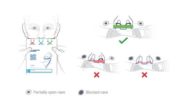 Illustration that shows how to select the right cannula size based on the patient's characteristics