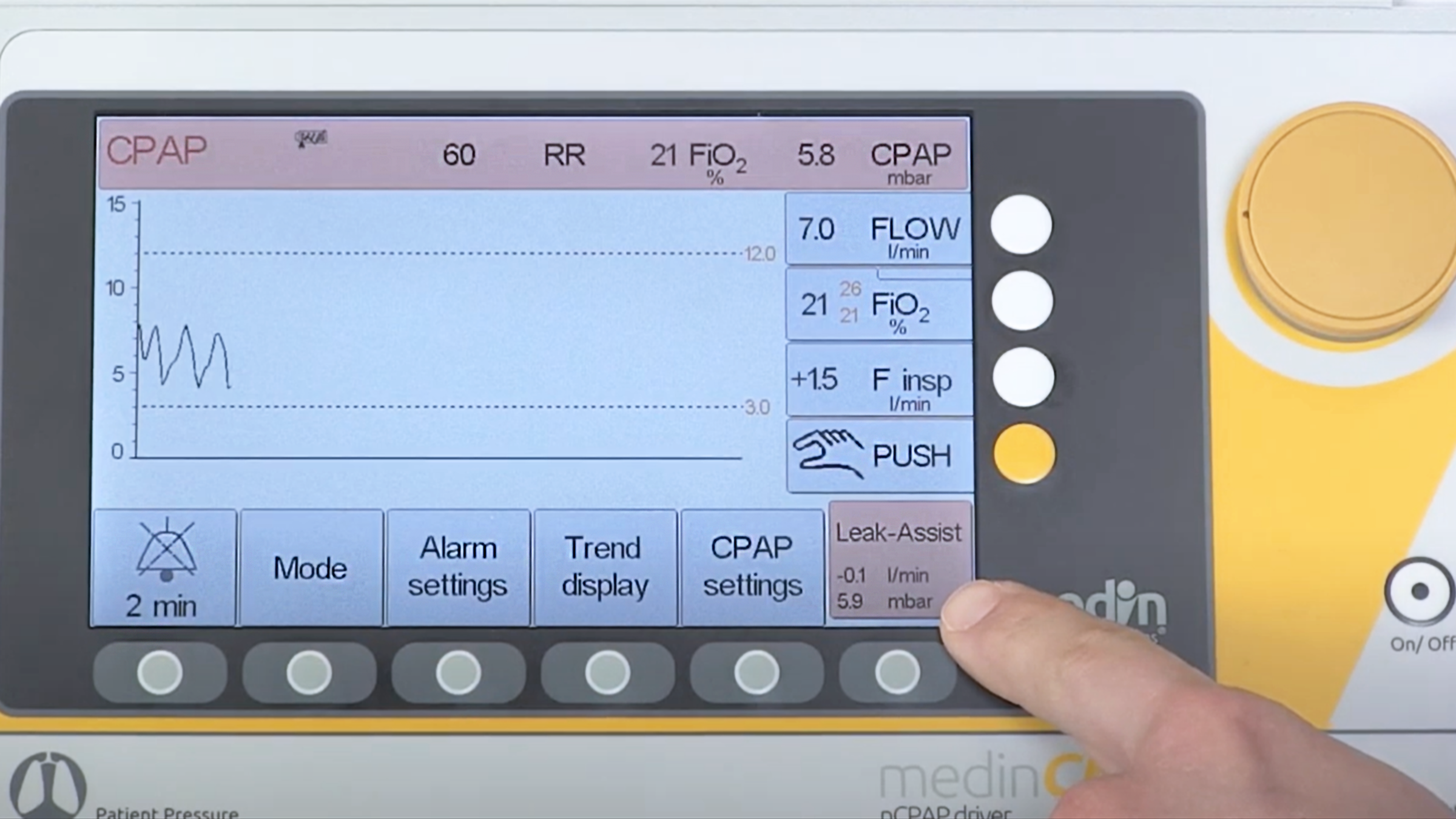 This video gives you a short overview on the functions and modes of the medinCNO nCPAP driver. medinCNO is used as stationary nCPAP driver for the nCPAP therapy of neonates and premature infants treated in combination with the nCPAP generator Medijet in intensive care units. medinCNO® may only be used in combination with simultaneous and constant hemodynamic monitoring of the patient, only by trained medical personnel and only during clinical use.