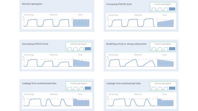 Basic waveform capnography as a continuous monitoring tool during 