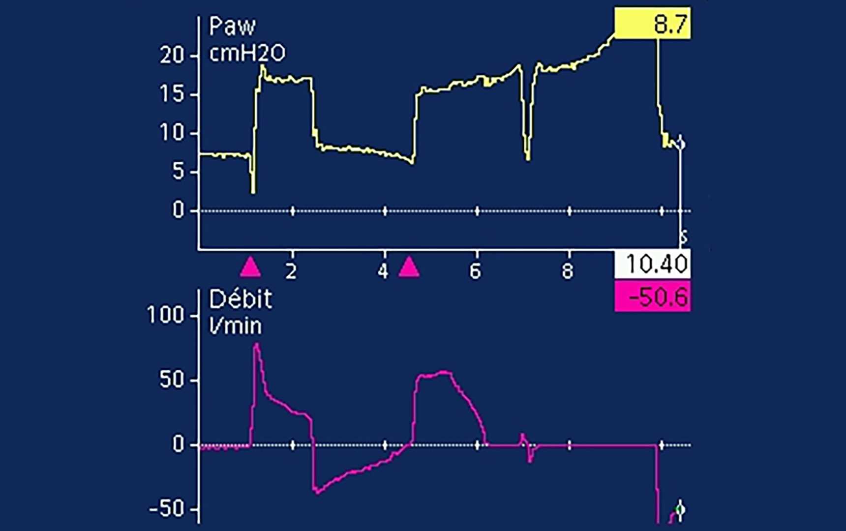 Screenshot showing non-readable plateau pressure due to inspiratory and expiratory muscle activity