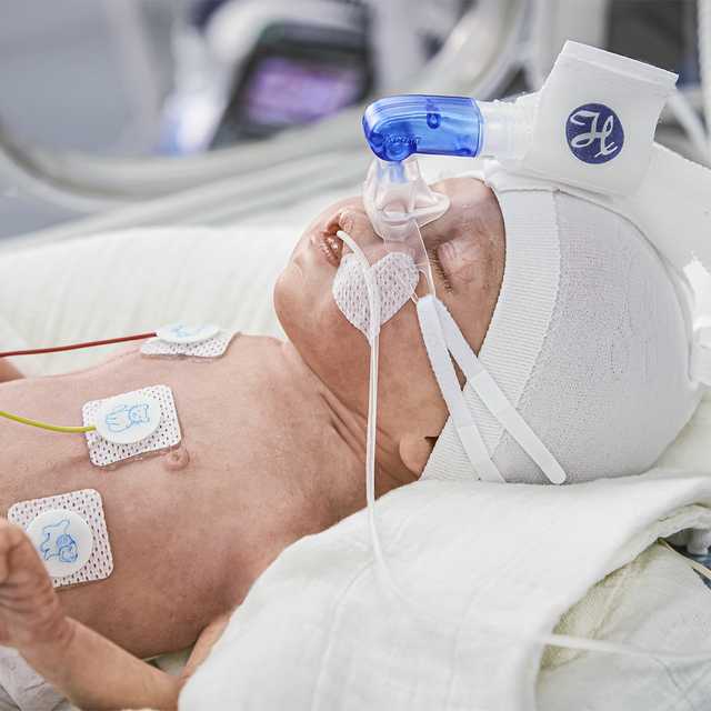 Paciente neonato con máscara para NIV