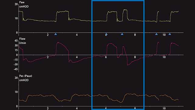 Esophageal pressure waveform showing decrease in pleural pressure