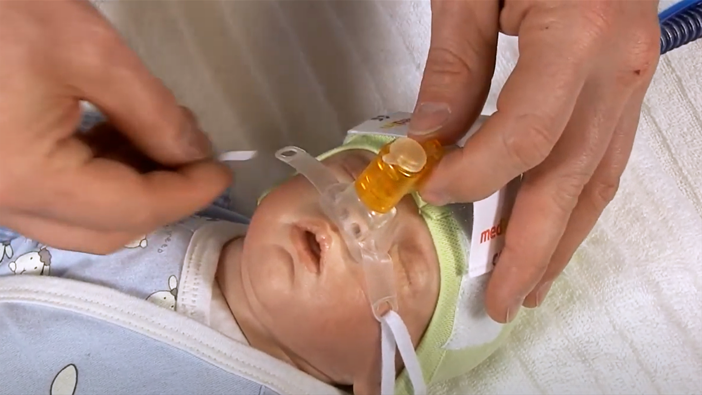 In this video we shortly demonstrate how to correctly use the medin Medijet generator. Medijet supports spontaneous breathing of neonatal patients – premature as well as term newborn. Based on the Benveniste principle Medijet provides an adjustable constant positive pressure in the patient´s airway applicated through short binasal prongs and masks. Benefits: - Increase of FRC and improvement of lung compliance - Decrease of WOB - Less noise level Pulmonary gas transport can be improved and atelectasis prevented by nCPAP.