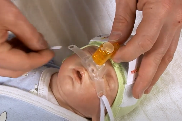 In this video we shortly demonstrate how to correctly use the medin Medijet generator. Medijet supports spontaneous breathing of neonatal patients – premature as well as term newborn. Based on the Benveniste principle Medijet provides an adjustable constant positive pressure in the patient´s airway applicated through short binasal prongs and masks.

Benefits:
- Increase of FRC and improvement of lung compliance
- Decrease of WOB
- Less noise level

Pulmonary gas transport can be improved and atelectasis prevented by nCPAP.