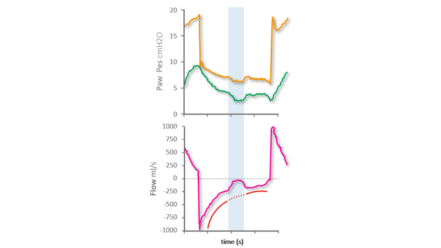 Pes waveform showing interruption to normal expiratory decrease