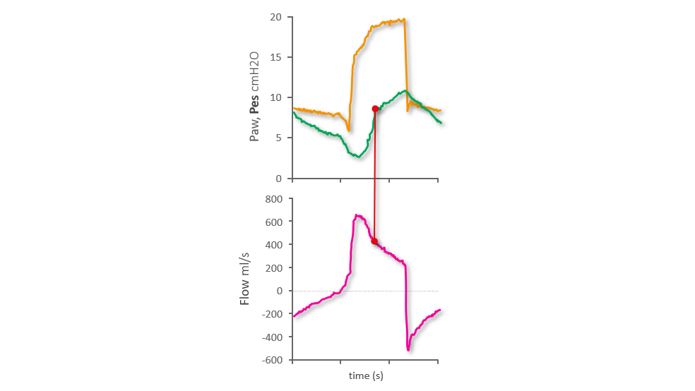 Pes waveform showing rise after nadir