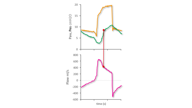 Pes waveform showing rise after nadir