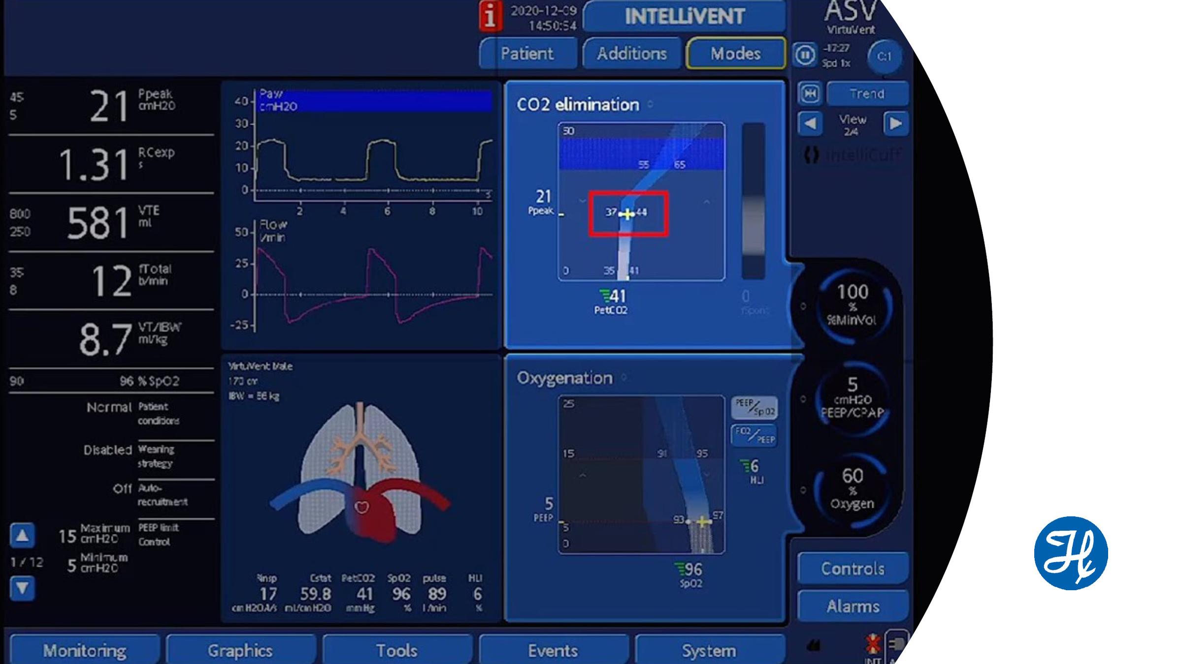 Using the target shift in INTELLiVENT®-ASV® | Hamilton Medical